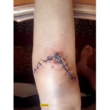 Trauma con machacamiento