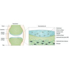 La resonancia magnética aclara etiopatogenia de la osteoartritis